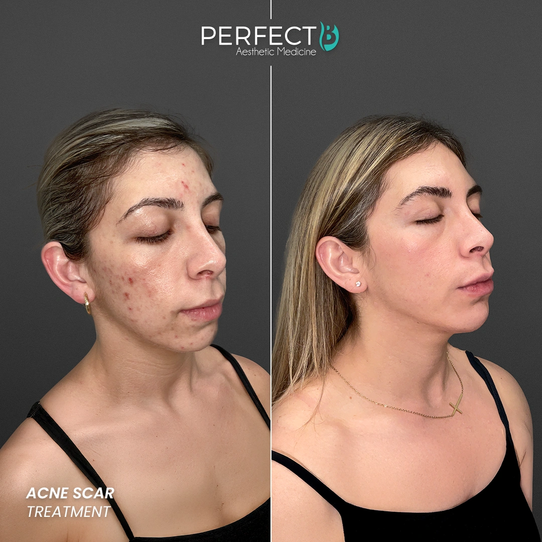 Perfect B - Results Image - [Acne Treatment] Case 4003 - 1080 x 1080