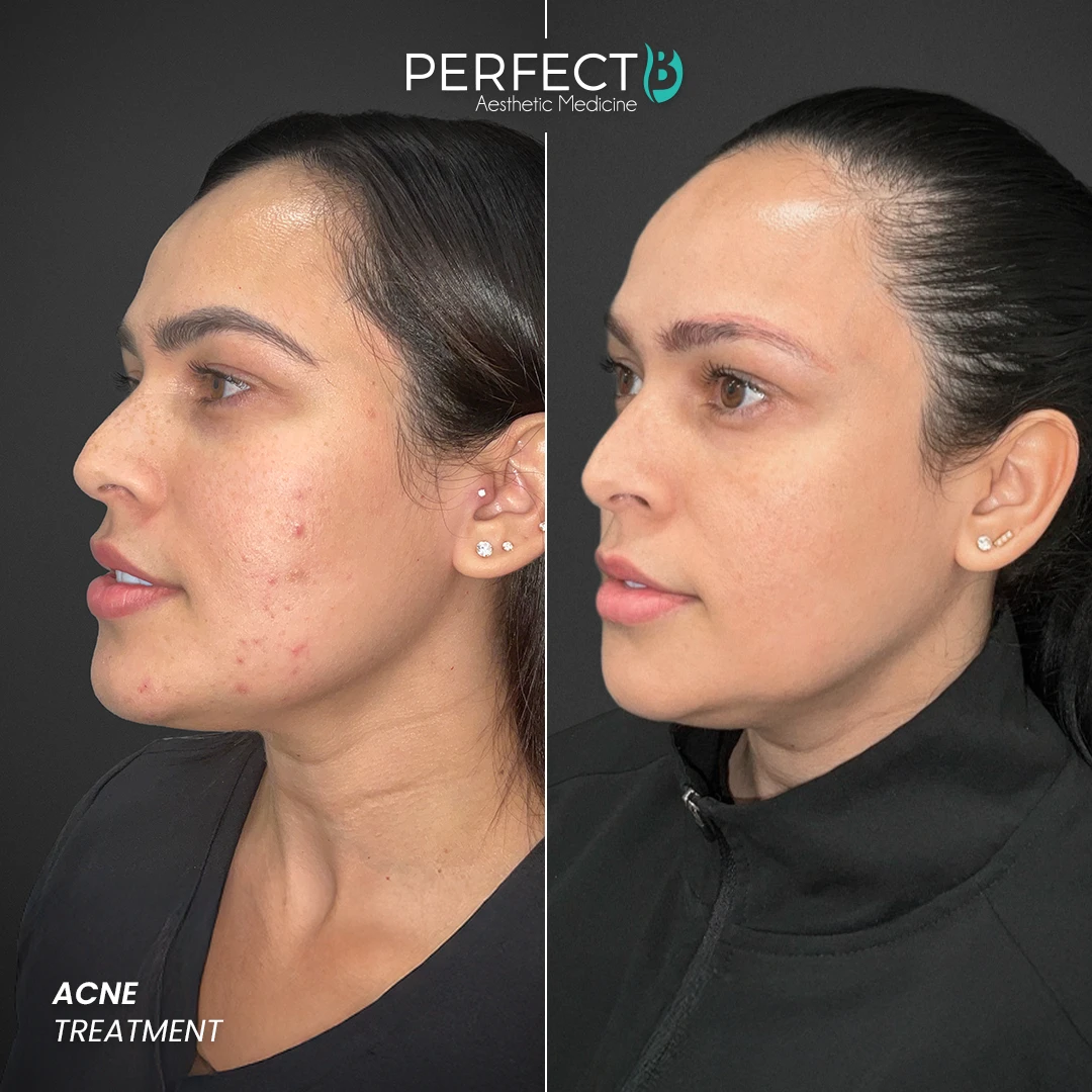 Perfect B - Results Image - [Acne Treatment] 4004 - 1080 x 1080