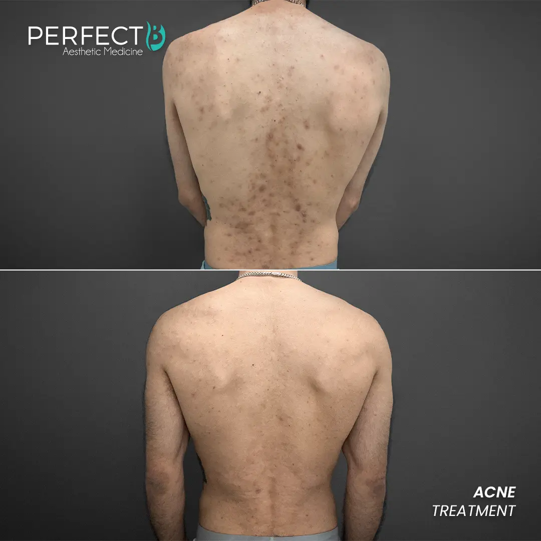 Perfect B - Results Image - [Acne Treatment] 4011 - 1080 x 1080