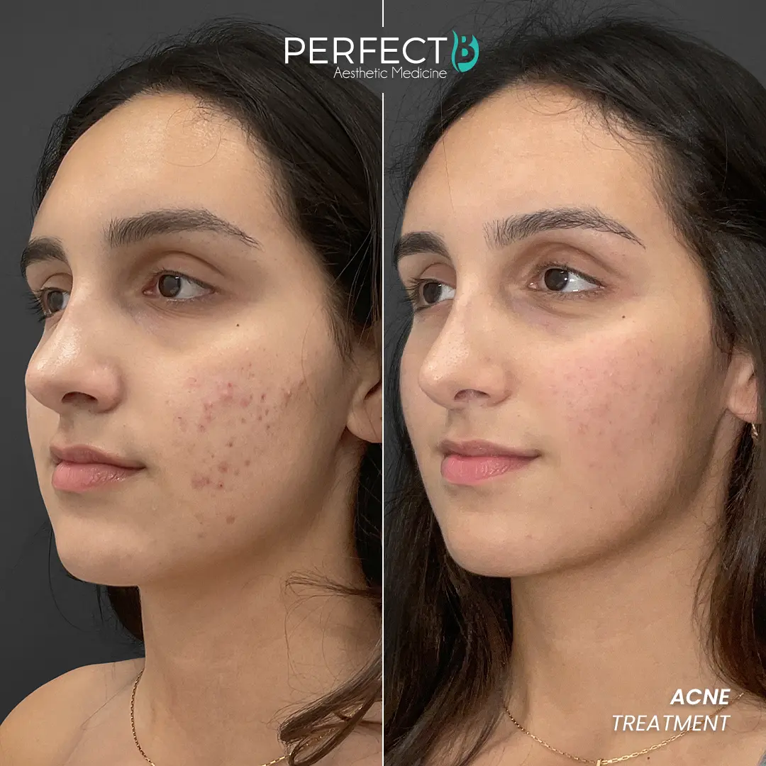 Perfect B - Results Image - [Acne Treatment] 4012 - 1080 x 1080