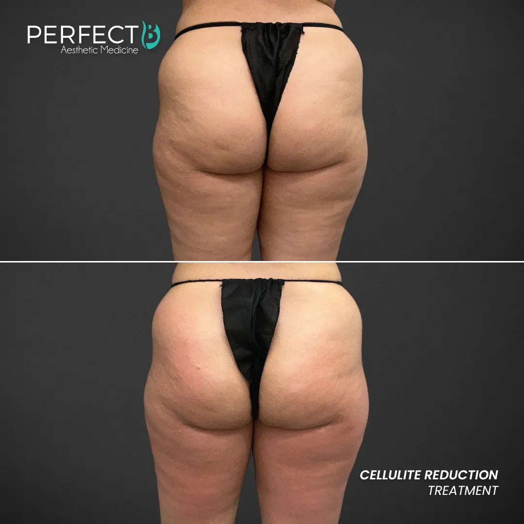Perfect B - Results Image - [Cellulite Reduction] 4000 - 1080 x 1080