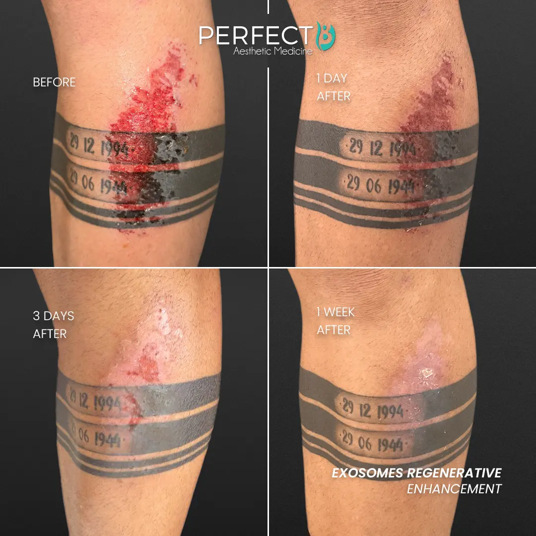 Perfect B - Results Image - [Exosomes Regenerative] 4000 - 1080 x 1080