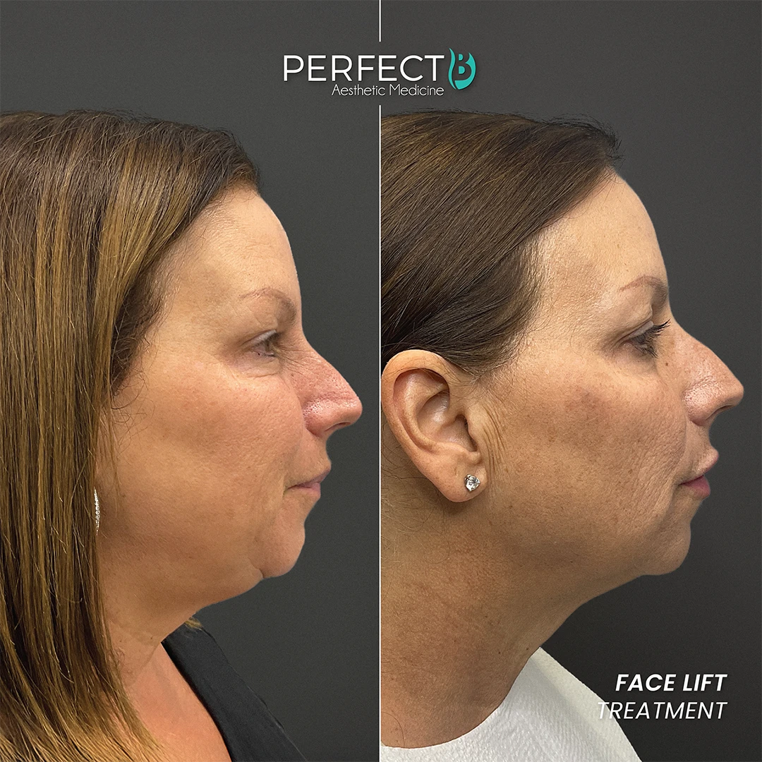Perfect B - Results Image - [Face Lift] 4002 - 1080 x 1080