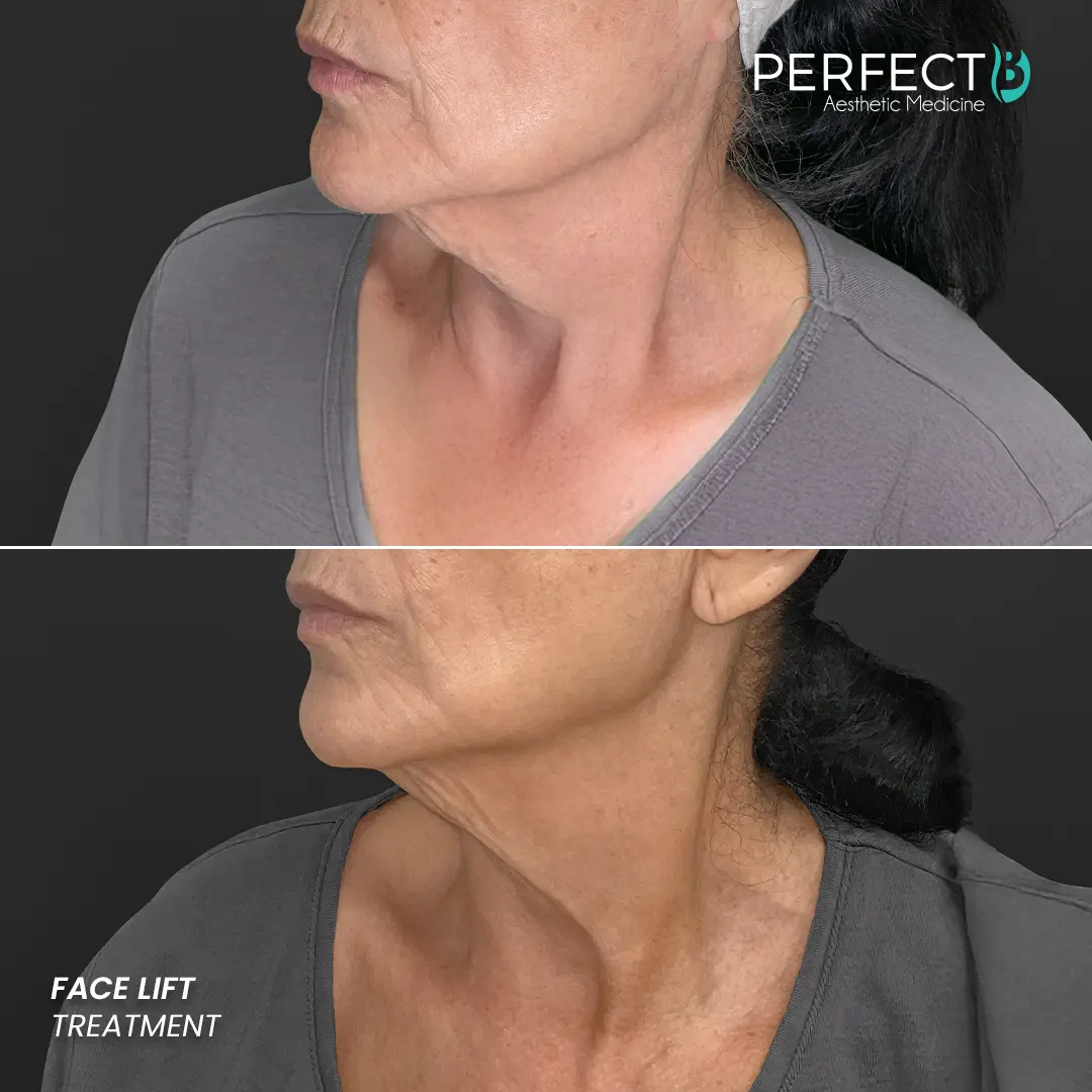 Perfect B - Results Image - [Face lift] 4007 - 1080 x 1080