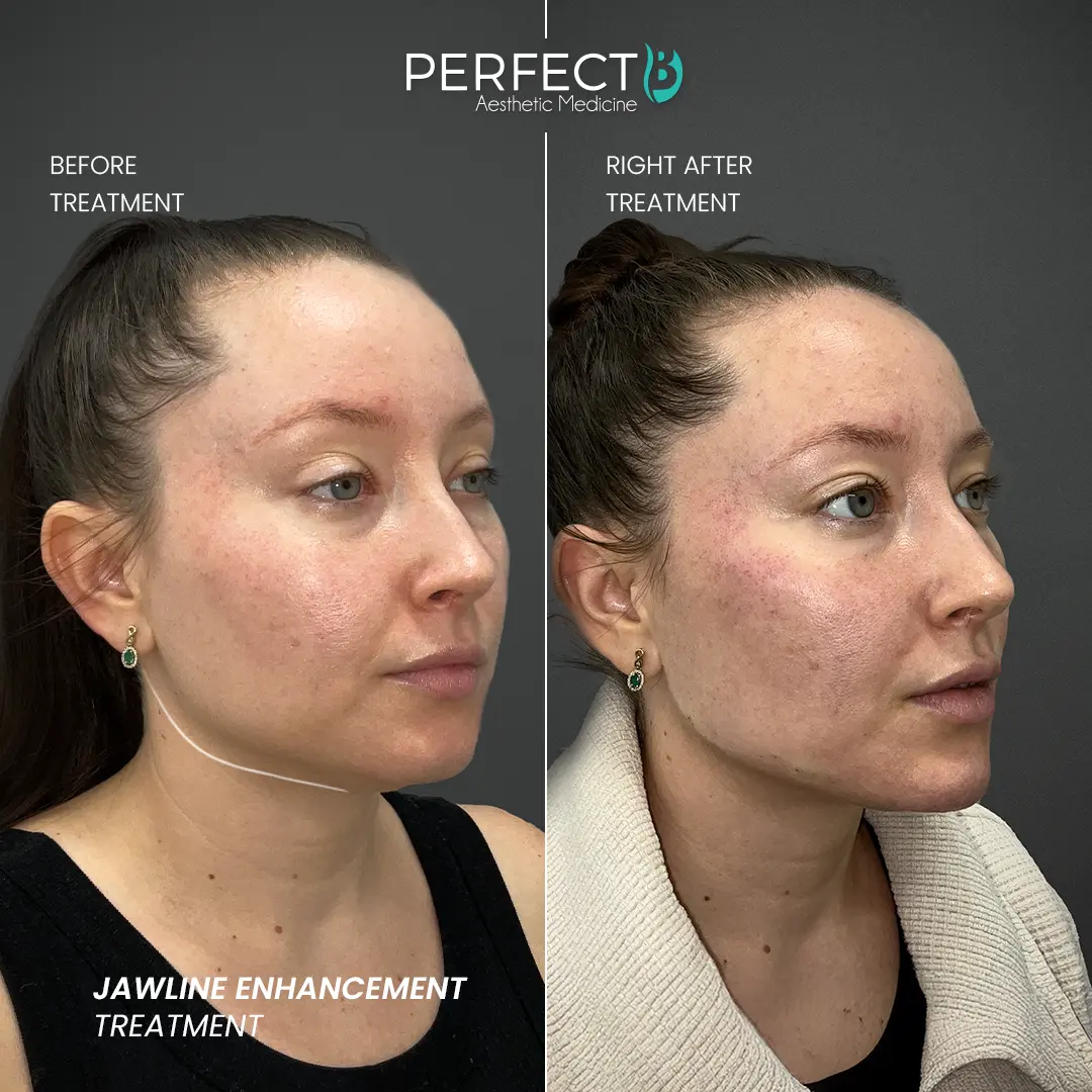 Perfect B - Results Image - [Jawline Enhancement] 4000 - 1080 x 1080
