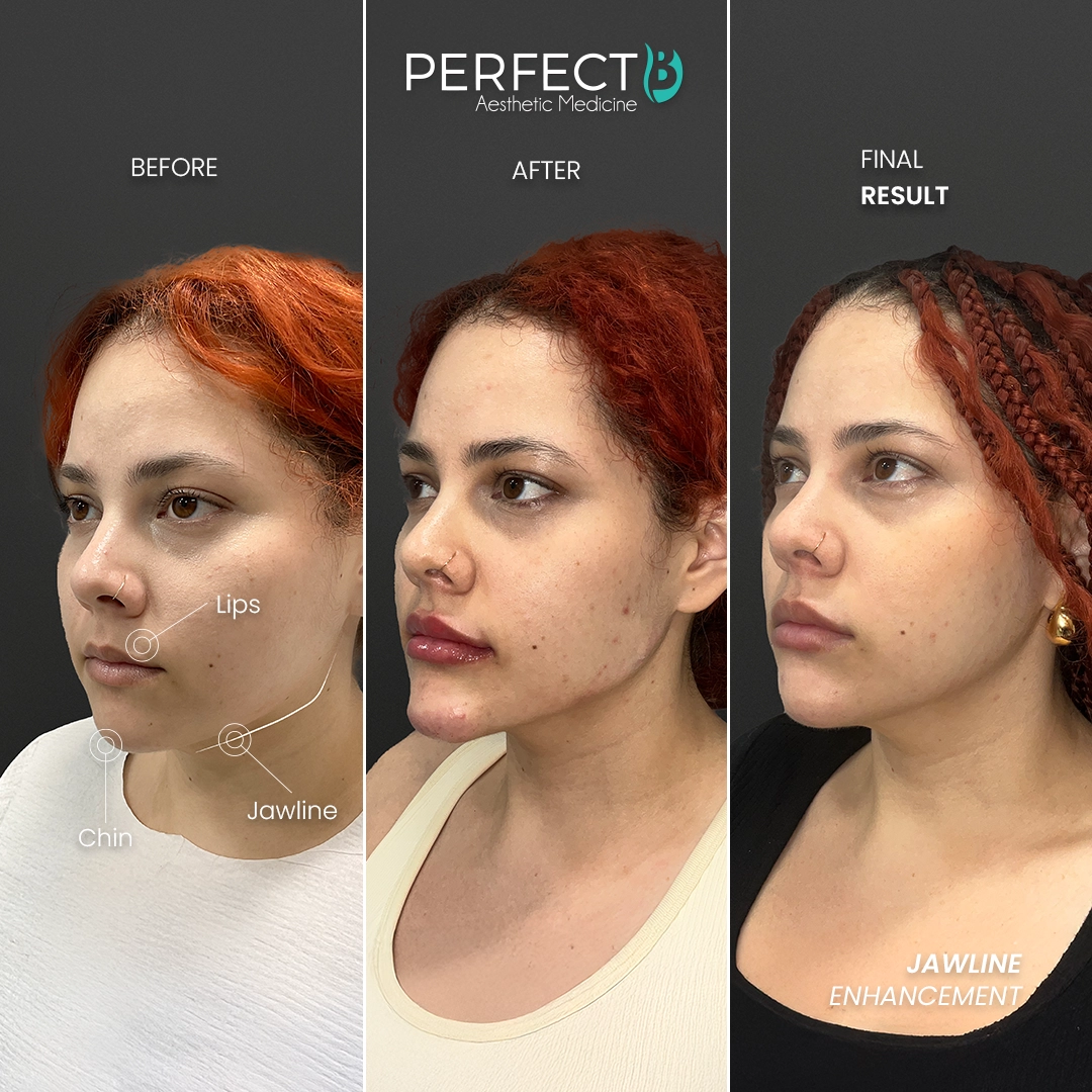 Perfect B - Results Image - [Facial Balancing] 4002 - 1080 x 1080