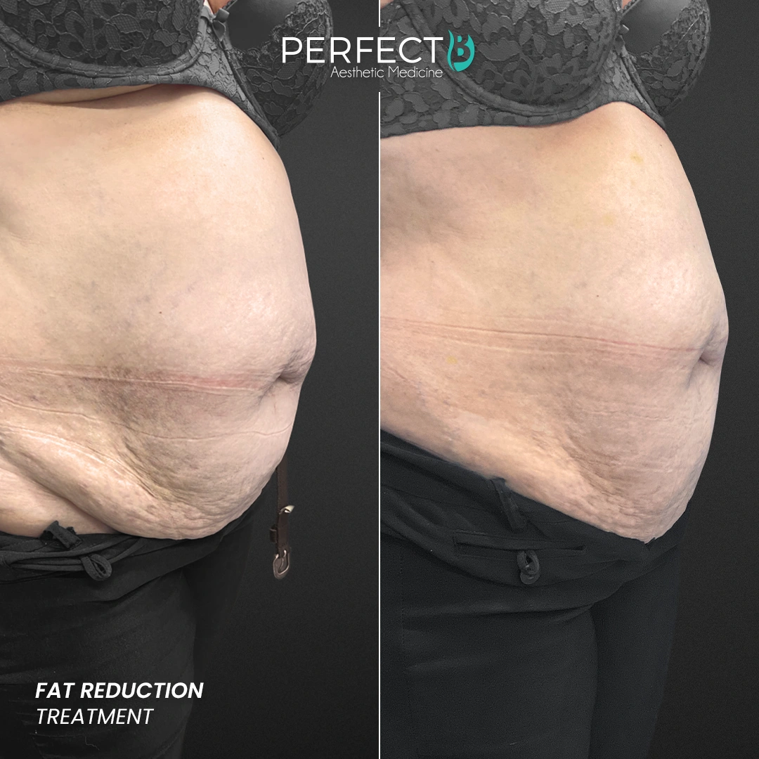 Perfect B - Results Image - [Fat Reduction] 4003 - 1080 x 1080