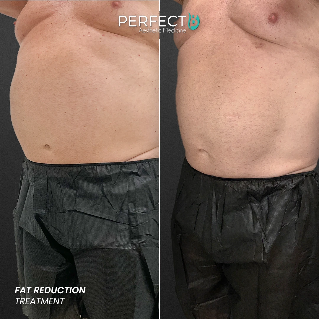 Perfect B - Results Image - [Fat Reduction] Case 4004 - 1080 x 1080