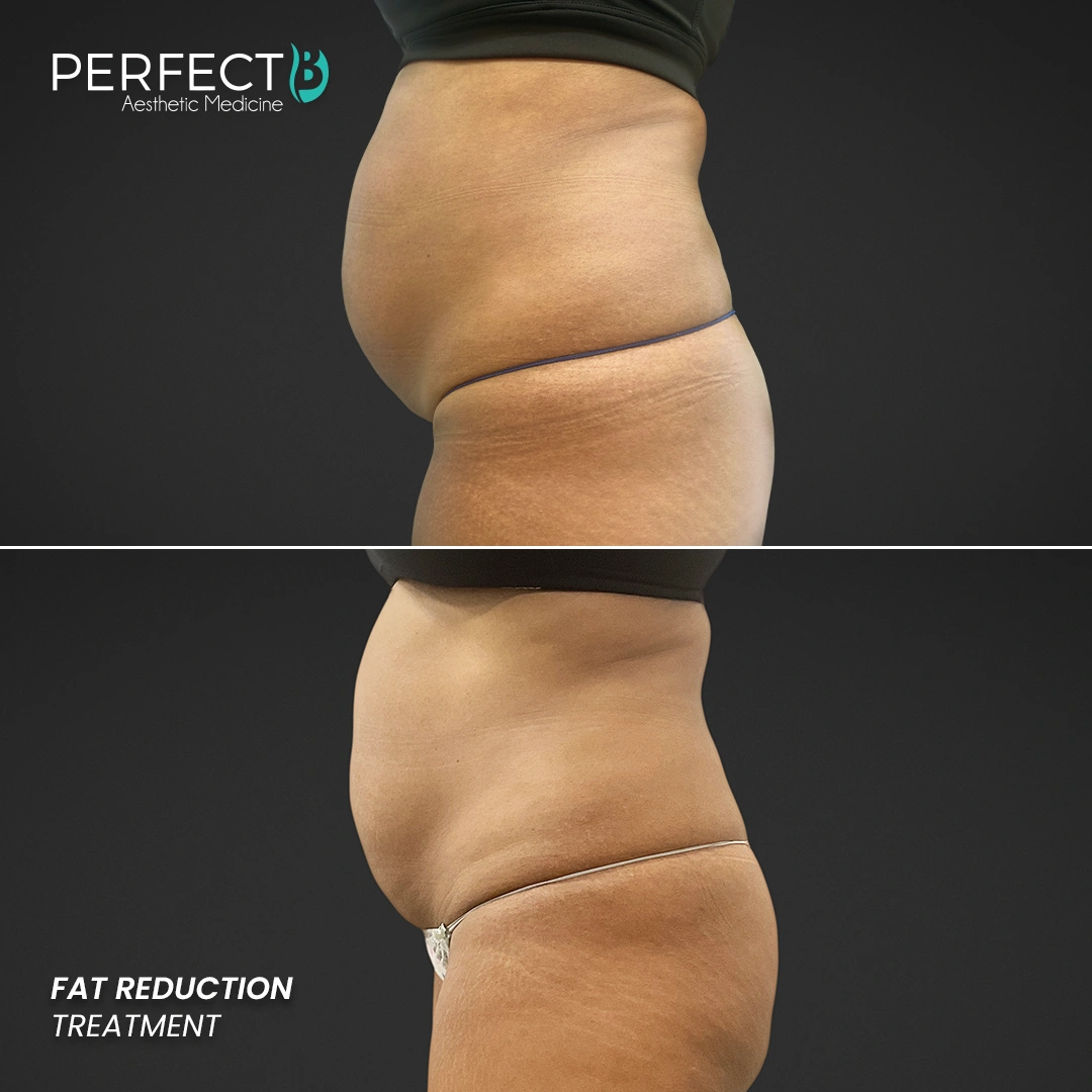 Perfect B - Results Image - [Fat Reduction] Case 5901 - 1080 x 1080