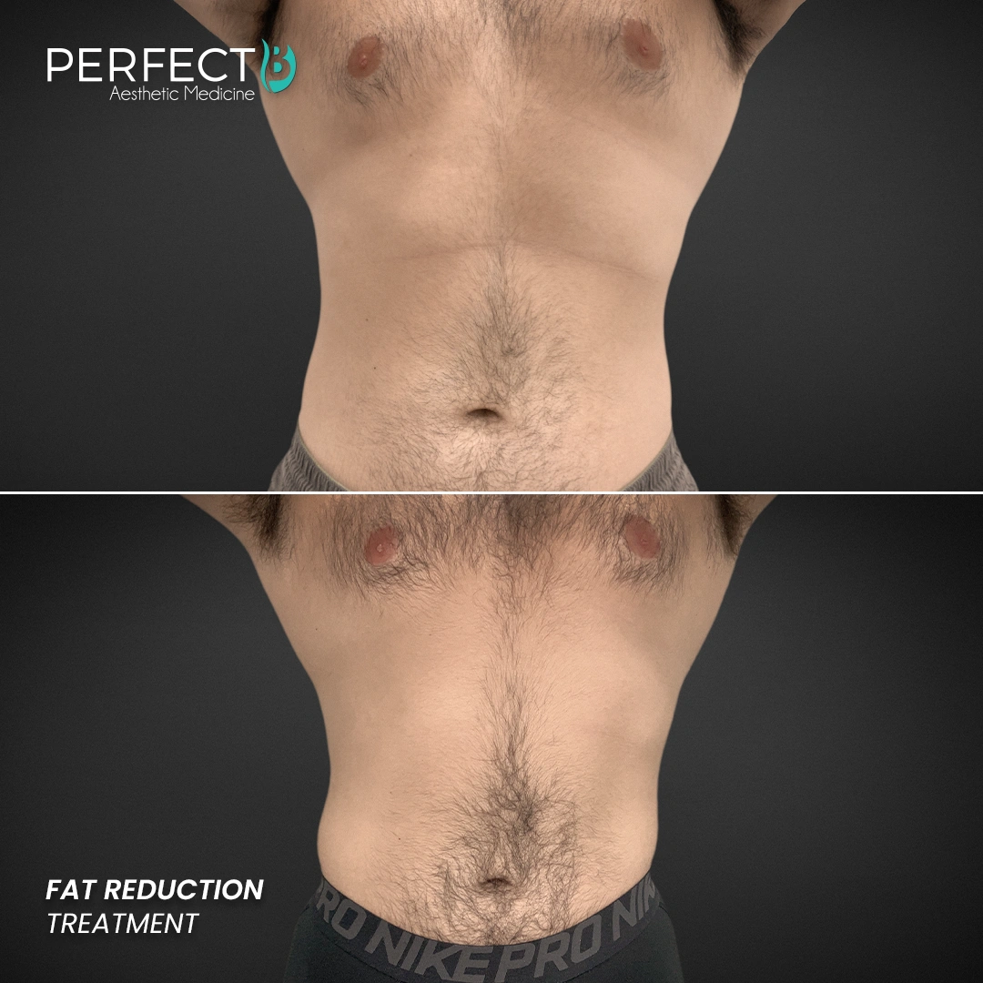Perfect B - Results Image - [Fat Reduction] Case 5902 - 1080 x 1080