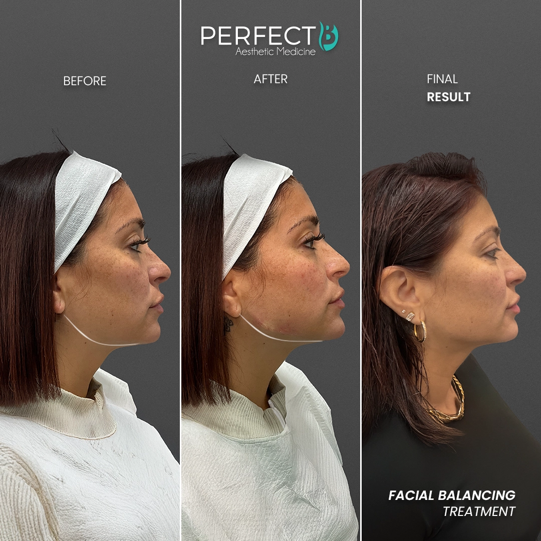 Perfect B - Results Image - [Jawline Enhacement] 4004 - 1080 x 1080