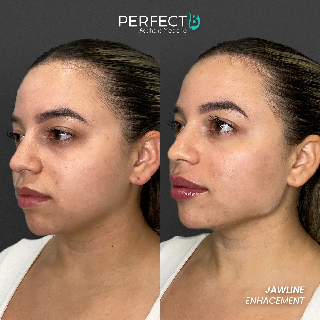 Perfect B - Results Image - [Jawline Enhacement] Case 6608 - 1080 x 1080