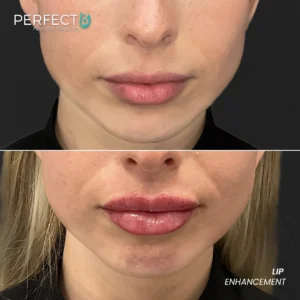 Perfect B - Results Image - [Lip Enhacement] 4008 - 1080 x 1080