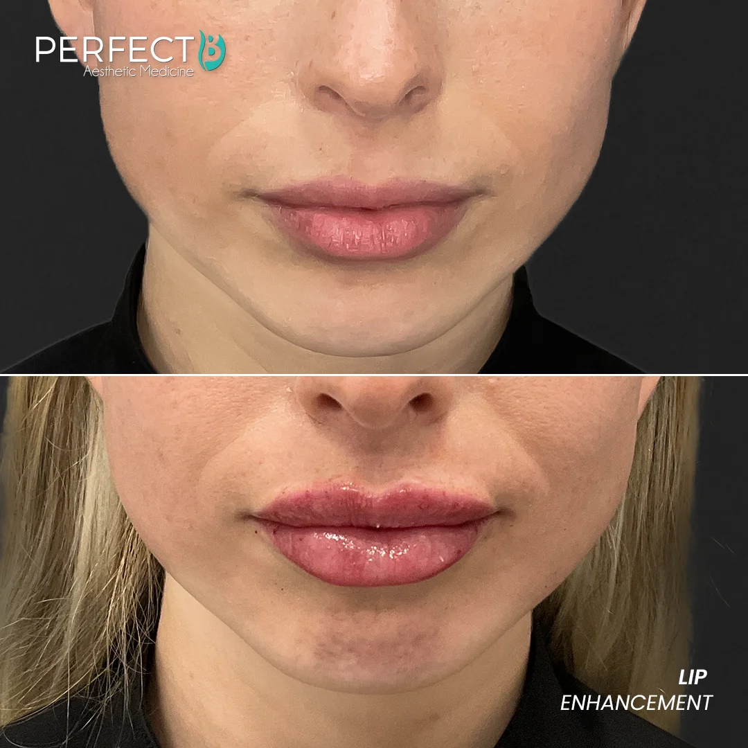 Perfect B - Results Image - [Lip Enhacement] 4008 - 1080 x 1080