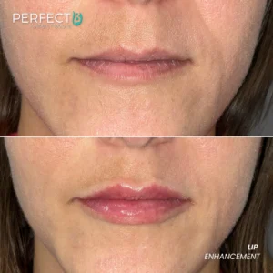 Perfect B - Results Image - [Lip Enhacement] 4003 - 1080 x 1080
