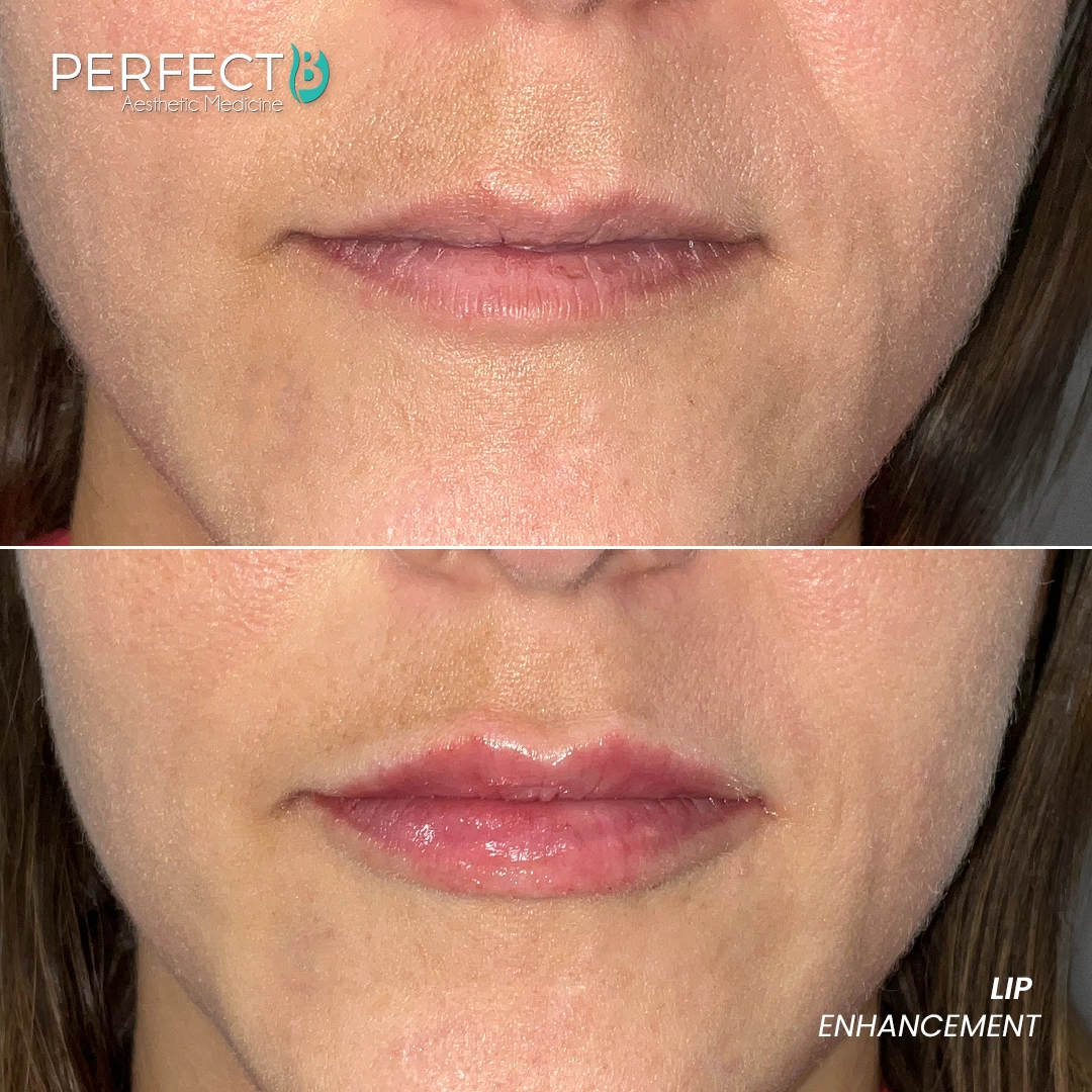 Perfect B - Results Image - [Lip Enhacement] 4003 - 1080 x 1080