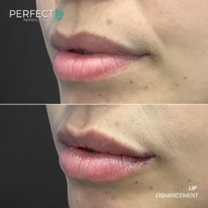 Perfect B - Results Image - [Lip Enhacement] 4011 - 1080 x 1080