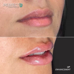 Perfect B - Results Image - [Lip Enhacement] 4026 B - 1080 x 1080