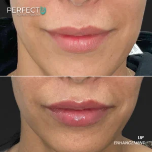 Perfect B - Results Image - [Lip Enhacement] 4033 - 1080 x 1080