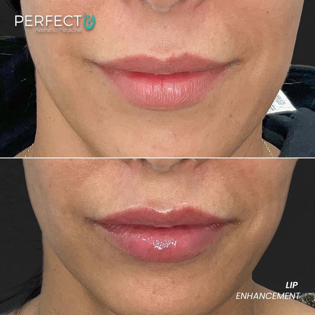 Perfect B - Results Image - [Lip Enhacement] 4033 - 1080 x 1080