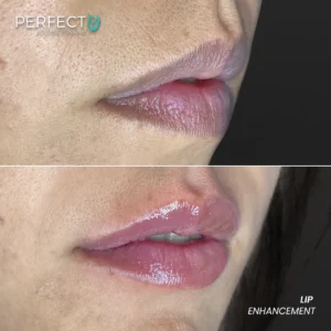 Perfect B - Results Image - [Lip Enhacement] 4033 - 1080 x 1080