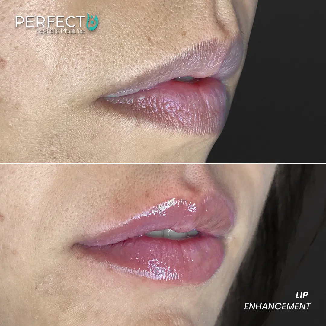 Perfect B - Results Image - [Lip Enhacement] 4033 - 1080 x 1080