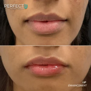 Perfect B - Results Image - [Lip Enhacement] 4034 - 1080 x 1080