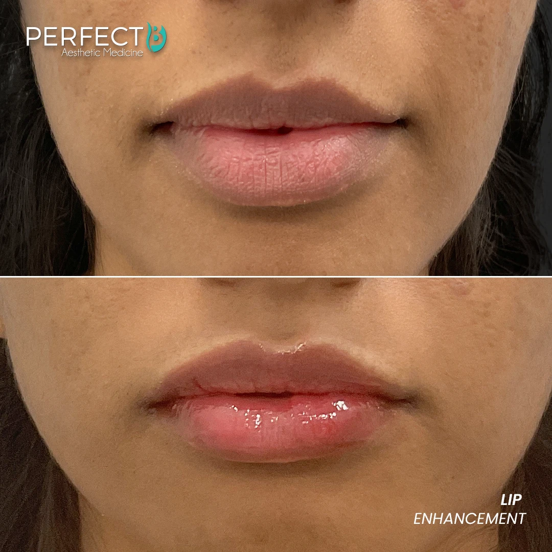 Perfect B - Results Image - [Lip Enhacement] 4034 - 1080 x 1080