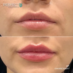 Perfect B - Results Image - [Lip Enhacement] 4038 - 1080 x 1080