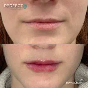 Perfect B - Results Image - [Lip Enhacement] 4043 - 1080 x 1080