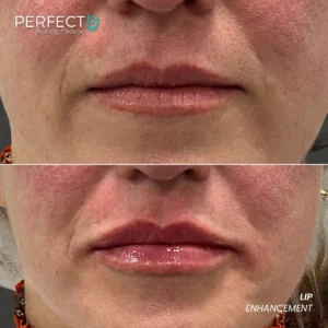 Perfect B - Results Image - [Lip Enhancement] 4002 - 1080 x 1080