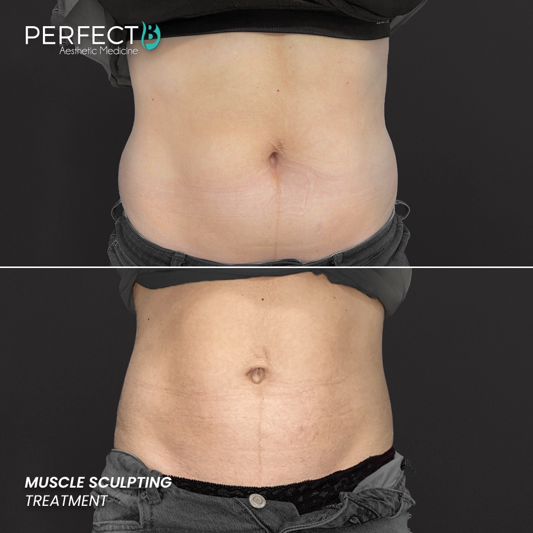 Perfect B - Results Image - [Muscle Sculpting] 4001 - 1080 x 1080