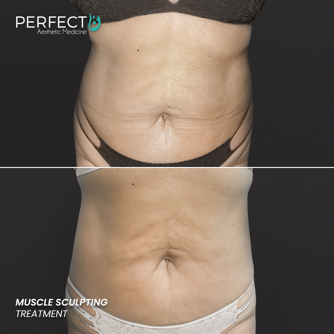 Perfect B - Results Image - [Muscle Sculpting] 4003 A - 1080 x 1080