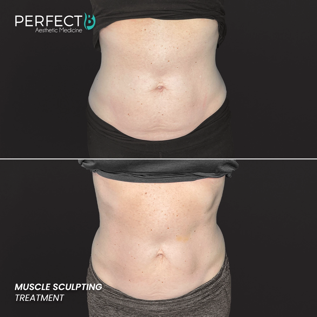 Perfect B - Results Image - [Muscle Sculpting] 4004 - 1080 x 1080