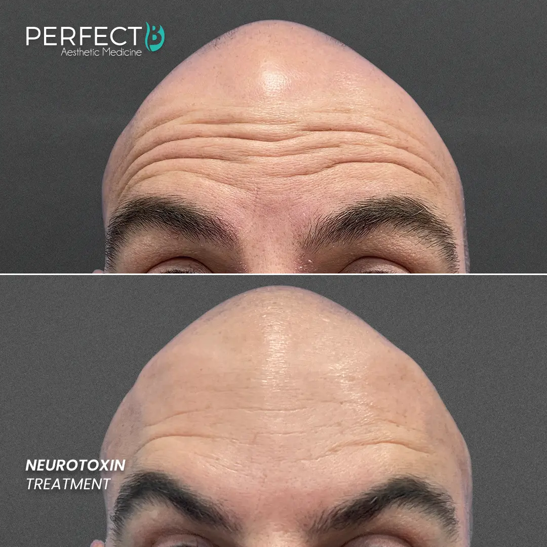 Perfect B - Results Image - [Neurotoxin] 4004 - 1080 x 1080