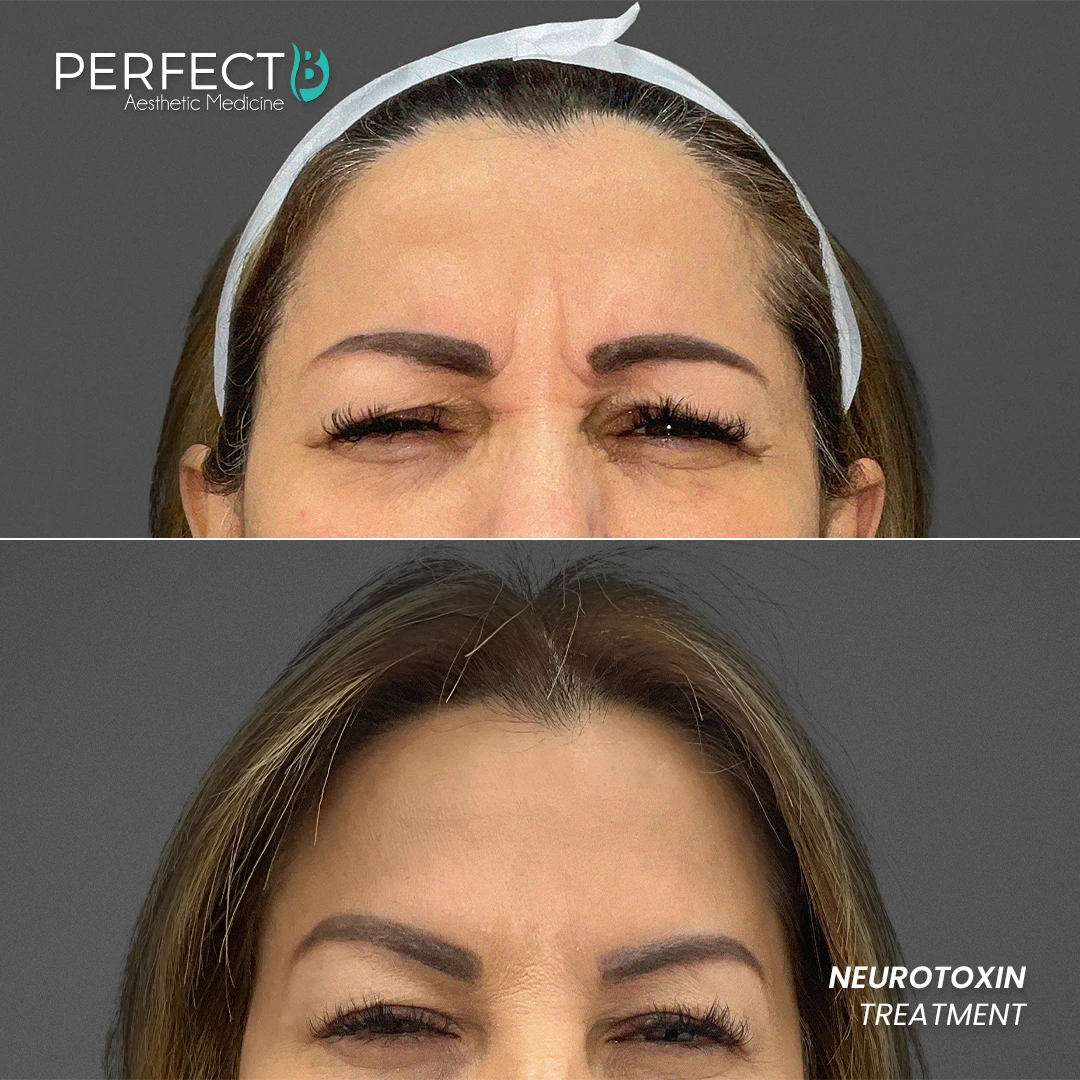 Perfect B - Results Image - [Neurotoxin] 4007 - 1080 x 1080