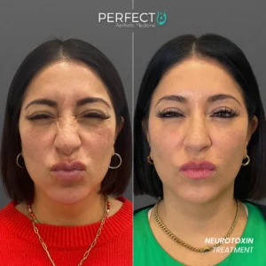 Perfect B - Results Image - [Neurotoxin Treatment] 4000 - 1080 x 1080
