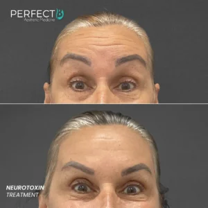 Perfect B - Results Image - [Neurotoxin Treatment] 4006 - 1080 x 1080