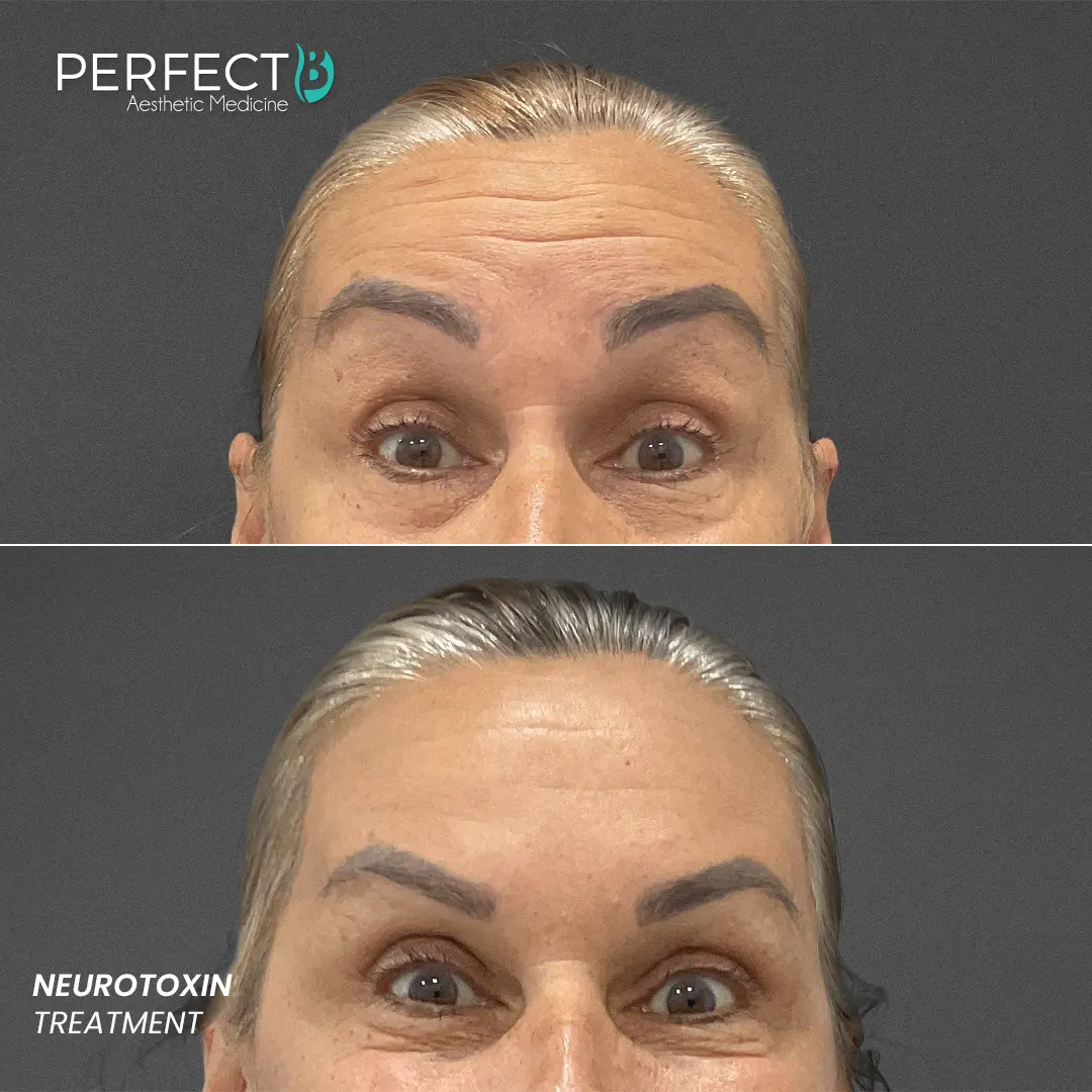 Perfect B - Results Image - [Neurotoxin Treatment] 4006 - 1080 x 1080