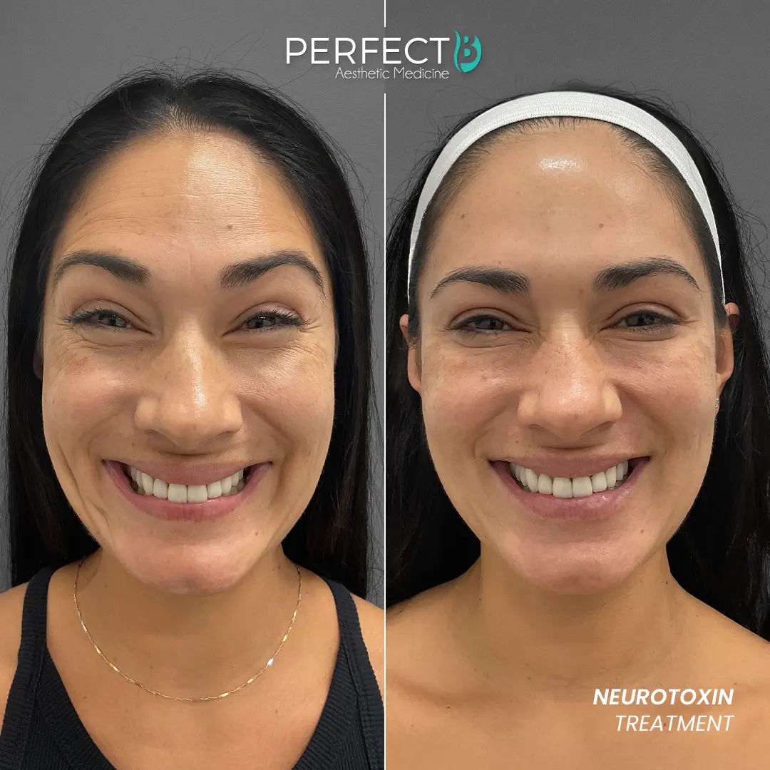 Perfect B - Results Image - [Neurotoxin Treatment] 4006 - 1080 x 1080