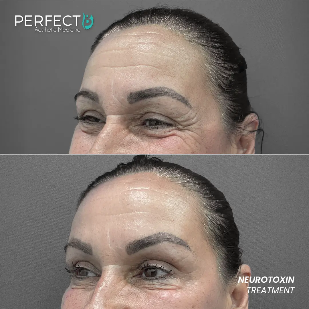 Perfect B - Results Image - [Neurotoxin Treatment] 4006 - 1080 x 1080