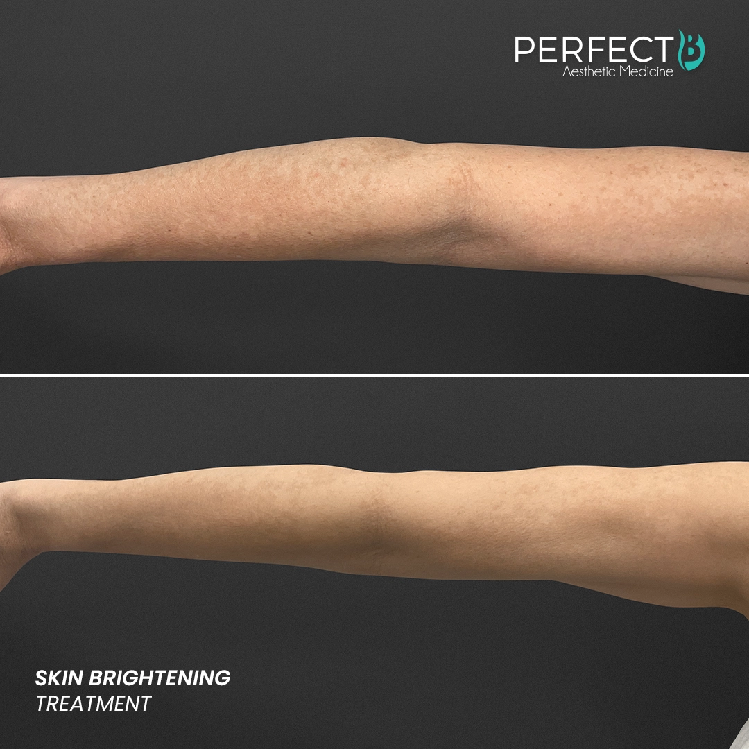 Perfect B - Results Image - [Skin Brightening] 4000 - 1080 x 1080