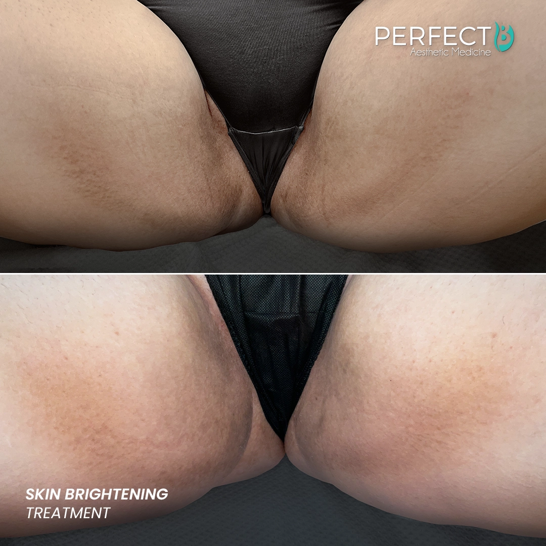 Perfect B - Results Image - [Skin Brightening] 4002 - 1080 x 1080