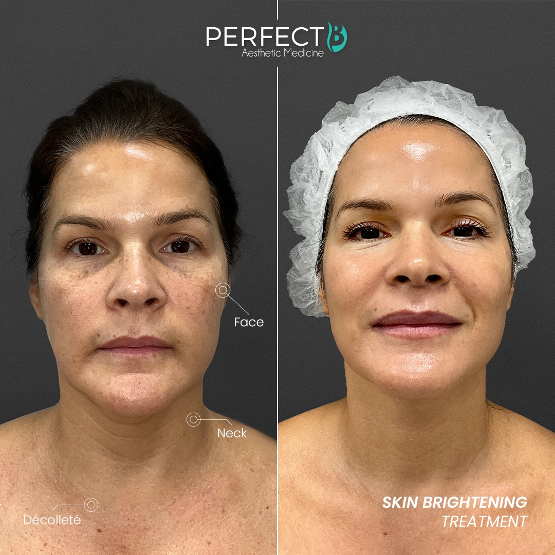 Perfect B - Results Image - [Skin Brightening] 4004 - 1080 x 1080
