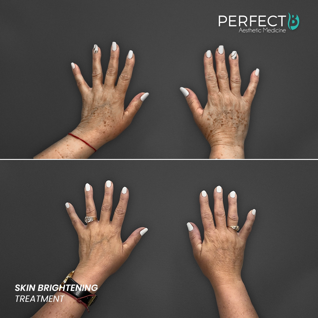 Perfect B - Results Image - [Skin Brightening] 4514 - 1080 x 1080