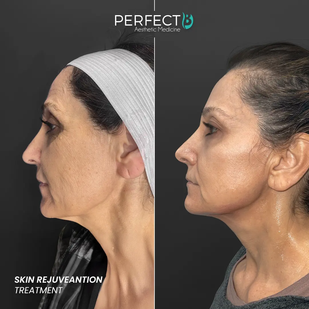 Perfect B - Results Image - [Skin Rejuveantion] 4005 - 1080 x 1080