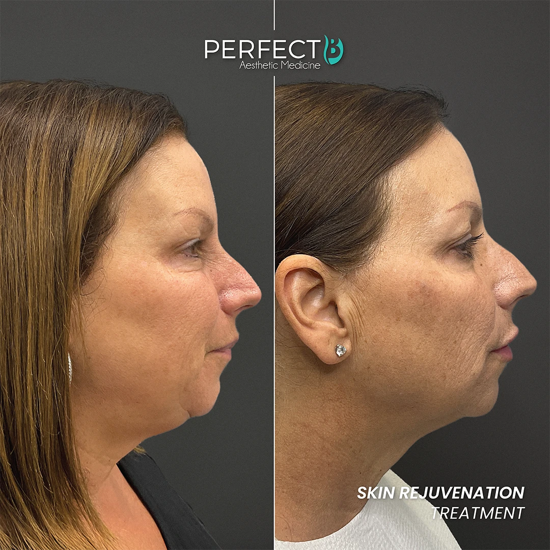Perfect B - Results Image - [Skin Rejuvenation] 4003 - 1080 x 1080