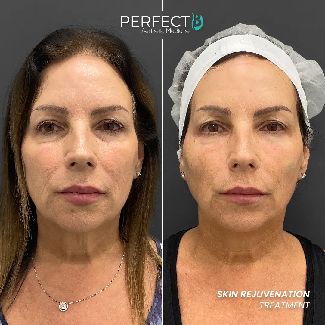Perfect B - Results Image - [Skin Rejuvenation] 4007 - 1080 x 1080