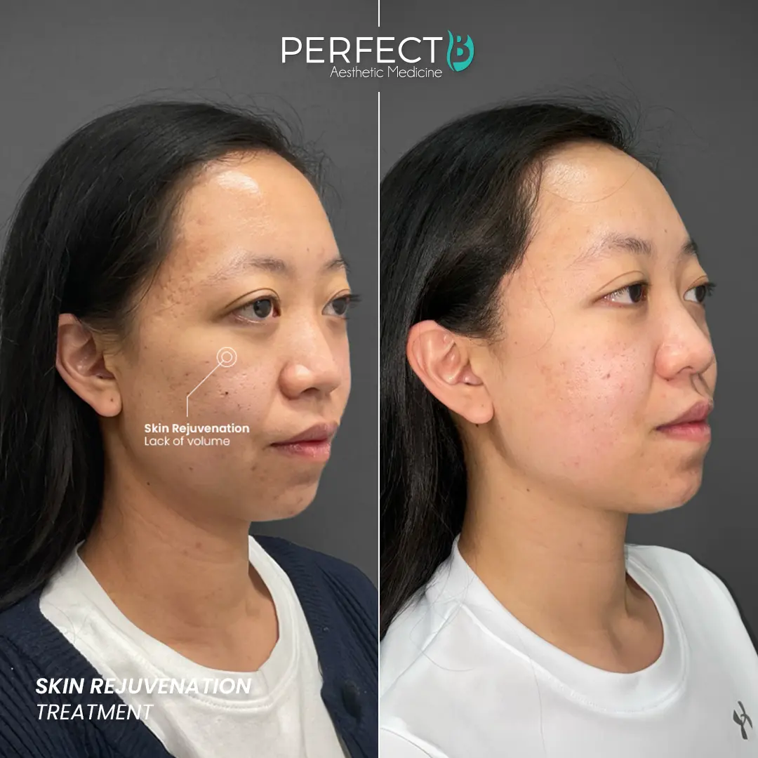 Perfect B - Results Image - [Skin Rejuvenation] 4007 - 1080 x 1080