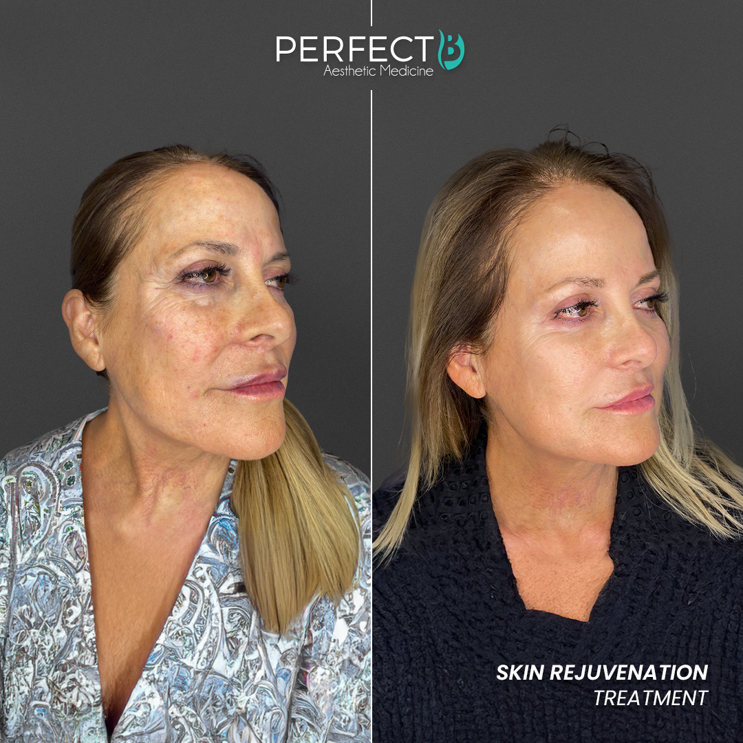 Perfect B - Results Image - [Skin Rejuvenation Treatment] 4002 - 1080 x 1080